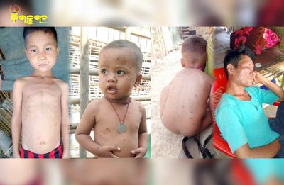 40 people, including minor children, infected with chickenpox in Kyauktaw IDP camp