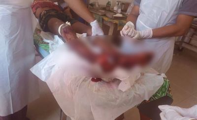 Four Muslim youths injured in Mrauk-U mine blasts; Two killed, 5 injured in Rakhine mine blasts within eight days